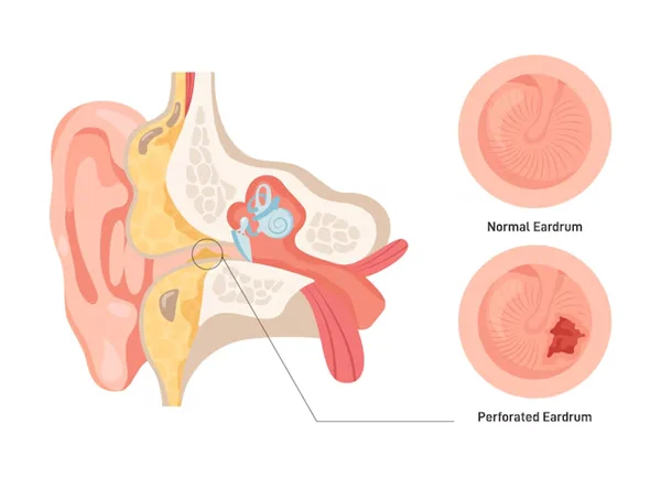 Ear Drum Repair Surgery
