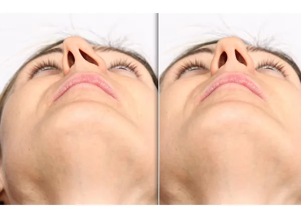 Septoplasty for Deviated Nose