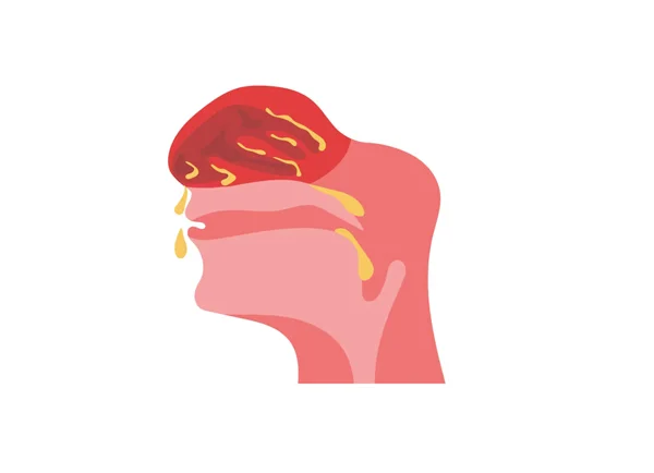 FESS for Treatment of Rhinitis and Sinusitis