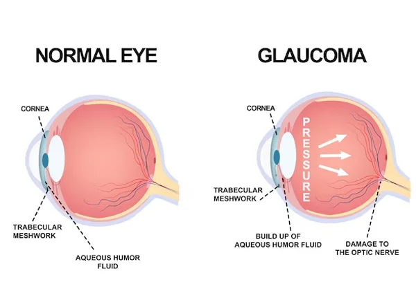 Glaucoma Services